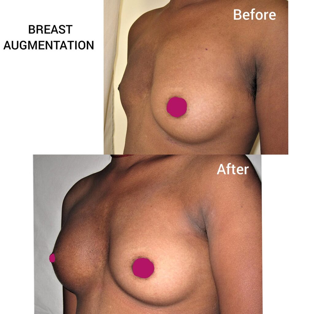 Breast_implant (1)