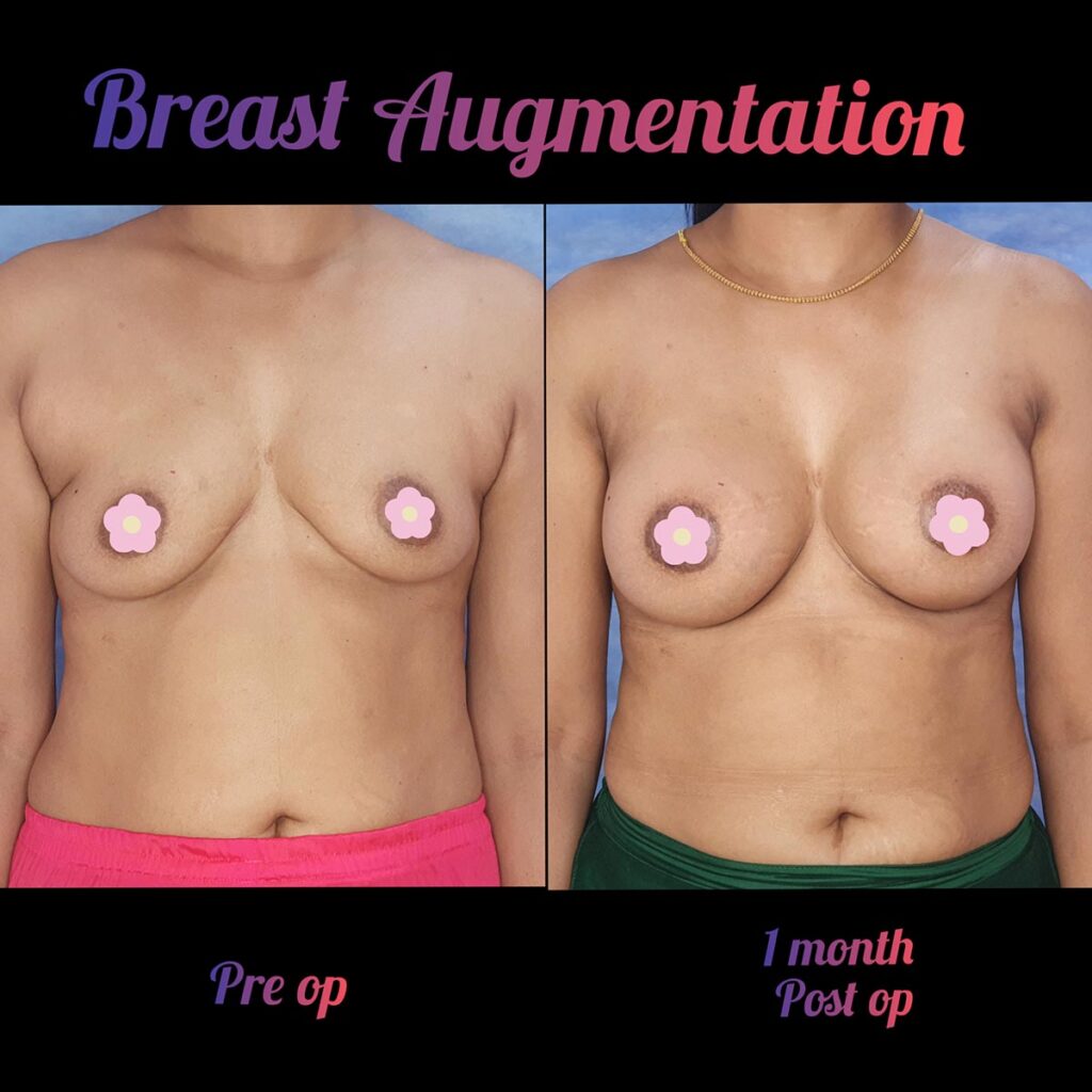 Breast_implant (3)