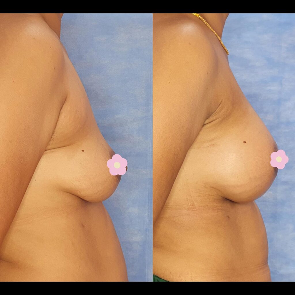 Breast_implant (4)
