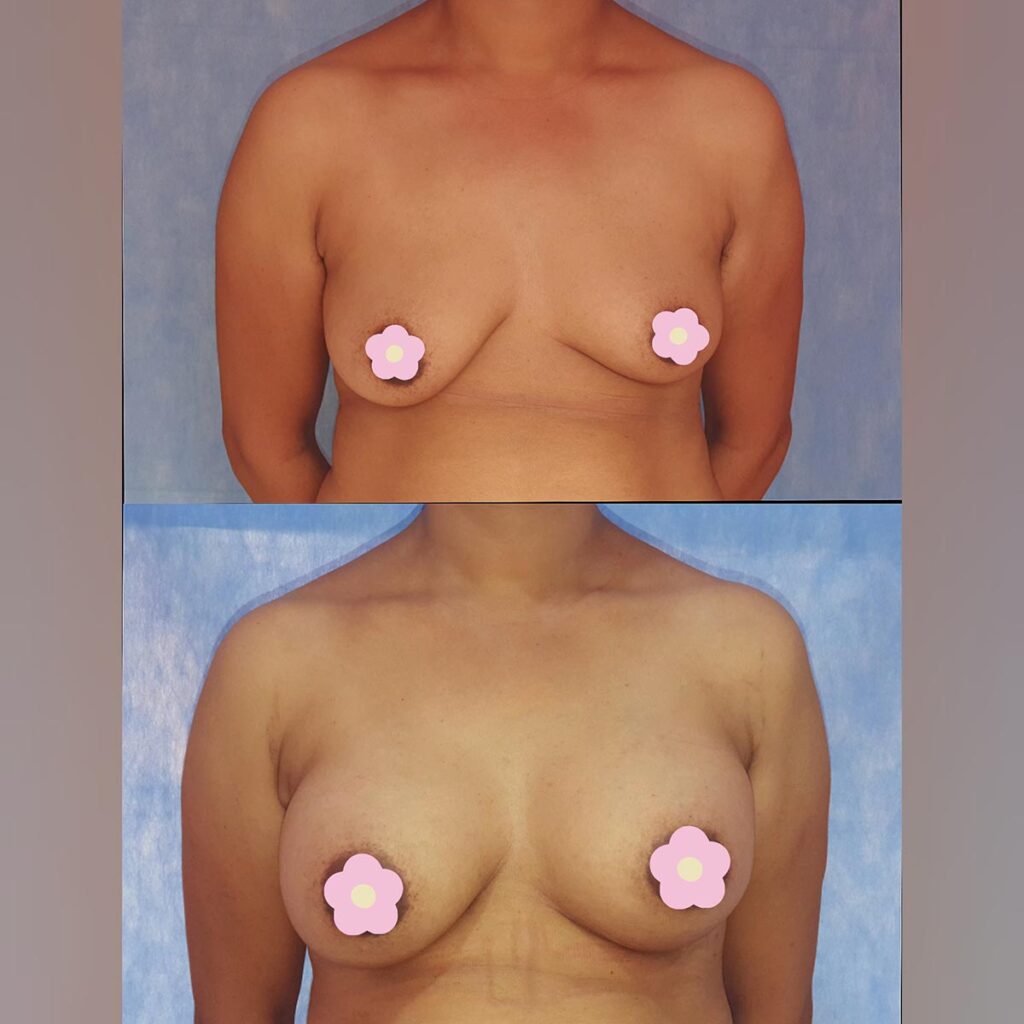 Breast_implant (5)