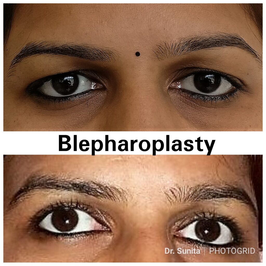 DrSunita_Blepharoplasty (2)